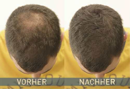 HairHelp Streuhaarfasern: Die Nr. 1 Haarverdichtung Bei Dünnem Haar Und Haarausfall