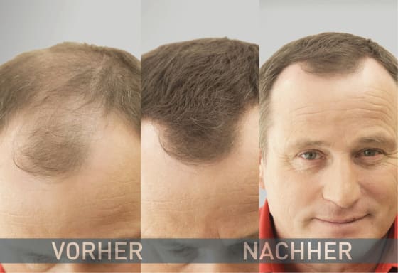 Streuhaar Haarverdichter 14 g Mittelbraun,